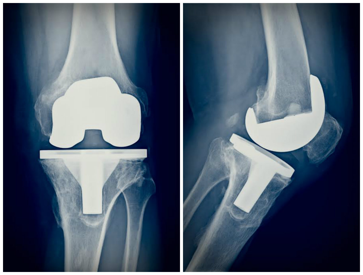 Zdrowe Kolano Endoprotezoplastyka Stawu Kolanowego 5086